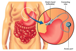 Adjustable-Gastric-Banding-Surgery-Diagram