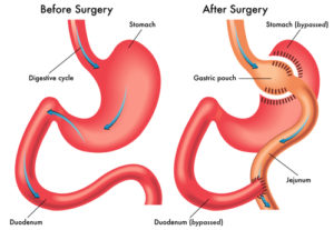 Gastric-Bypass-Surgery-Diagram