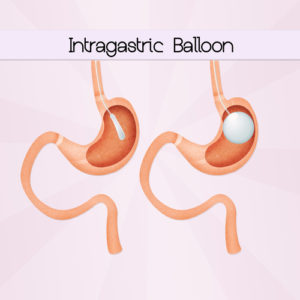 intragastric balloon surgery diagram