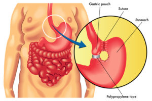 Vertical-Banded-Gastroplasty-Surgery-Diagram